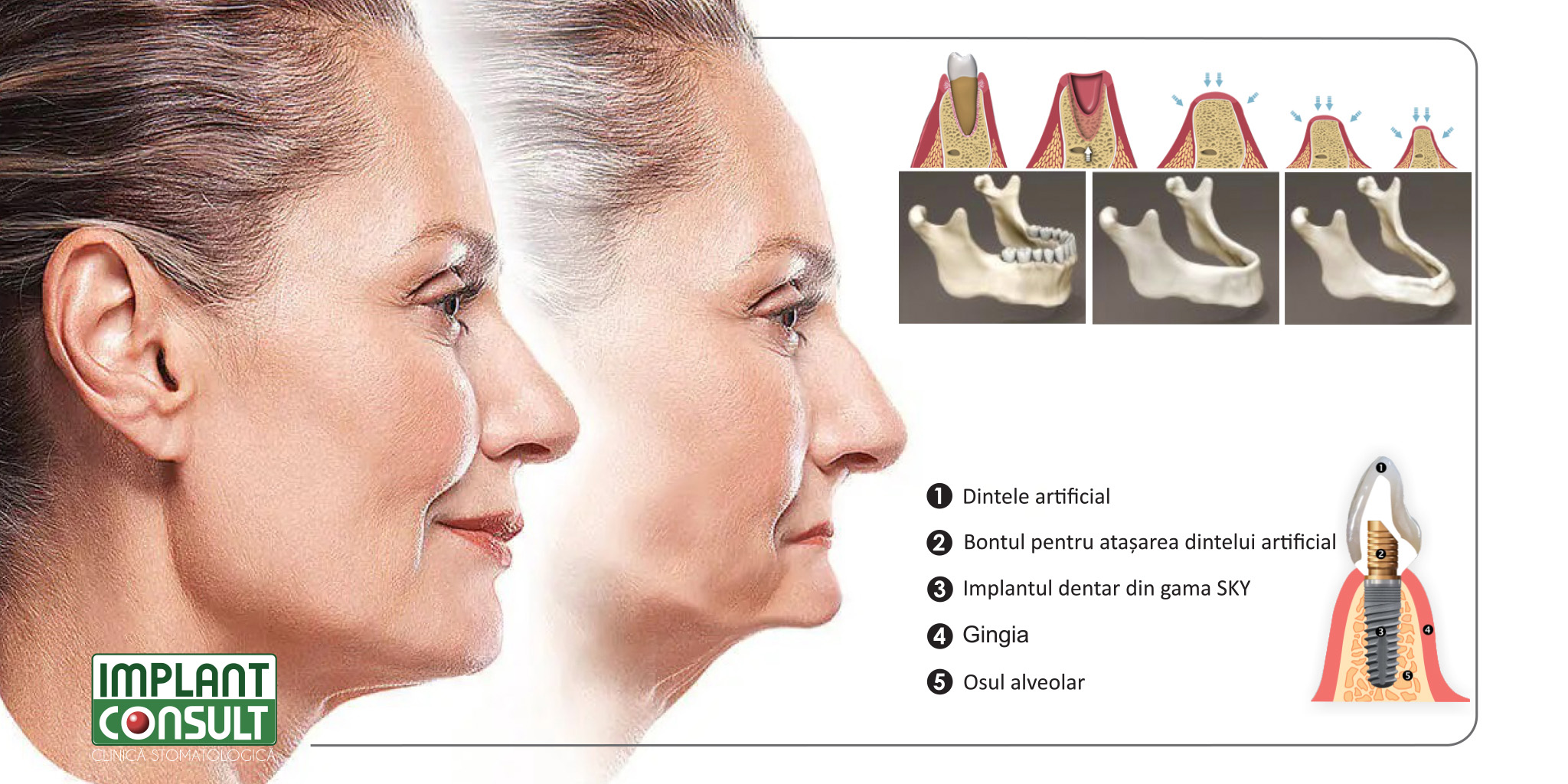 Resorbtia osului alveolar este stopata cand in locul dintelui extras este inserat un implant dentar