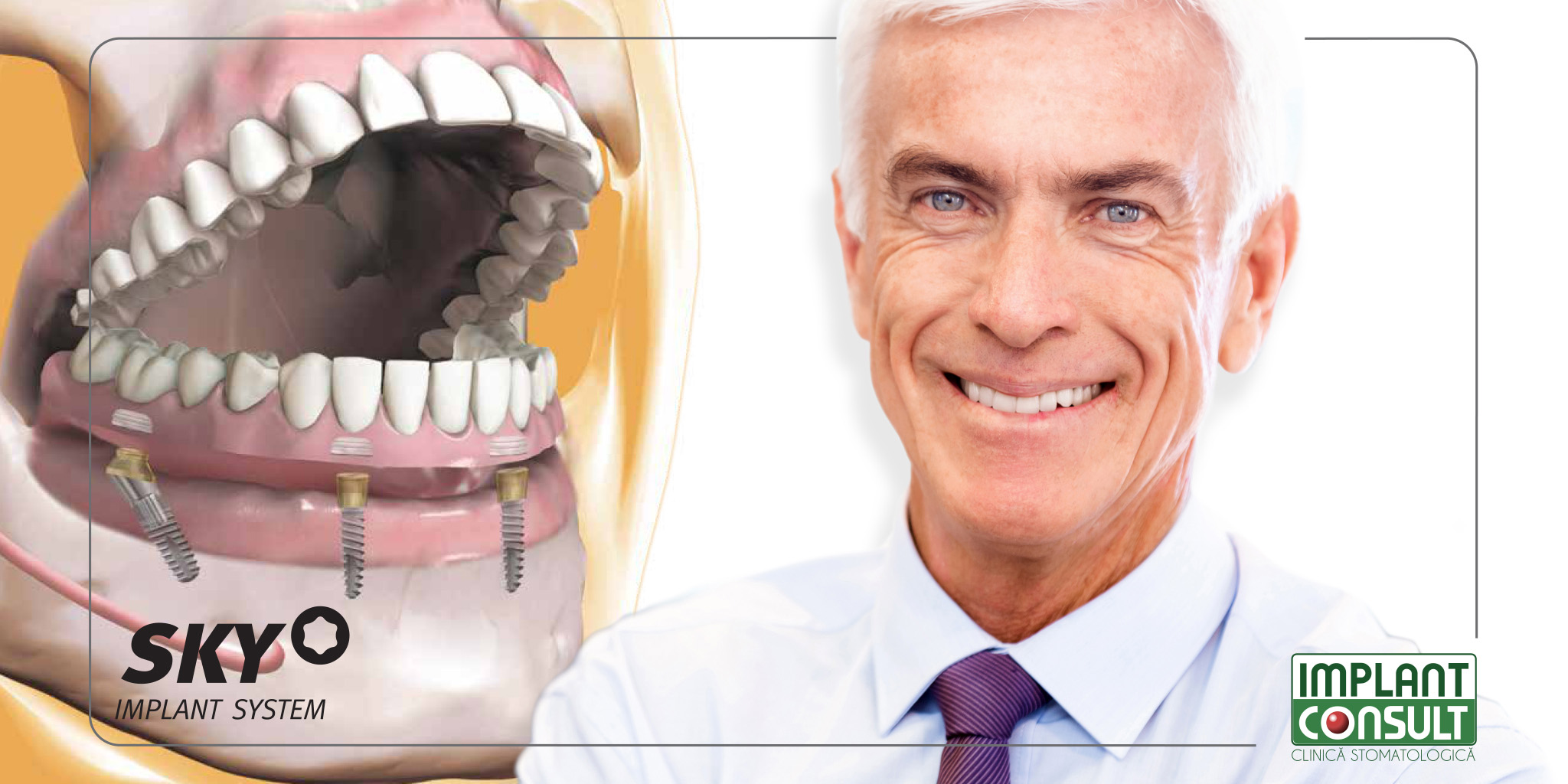 Fixarea protezei mobile fără cremă adezivă pe un suport de mini implanturi dentare la Implant Consult